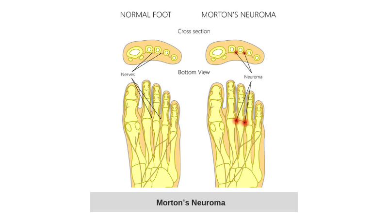 Diagram showing the location of pain in Morton's Neuroma.