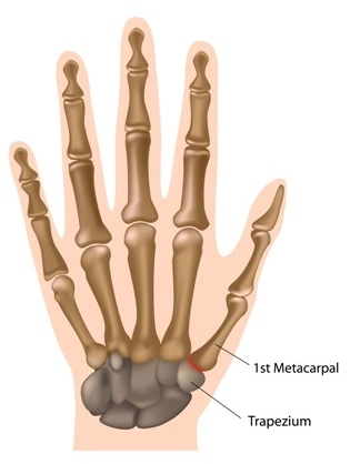 Thumb arthritis occurs at the base of the thumb between the metacarpal and trapezium bones.