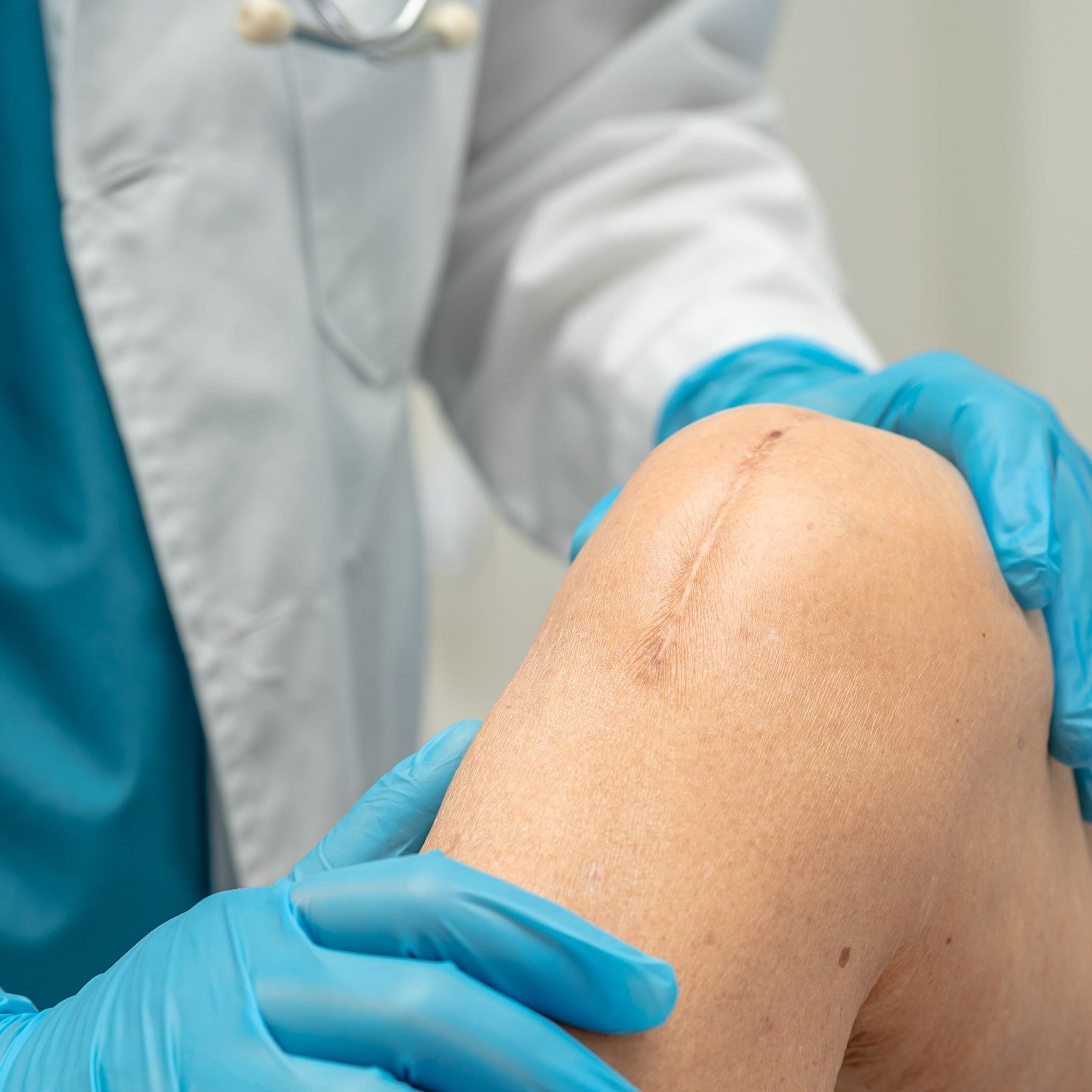 knee replacement scar
