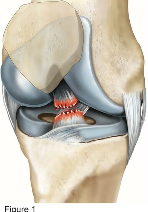 eido_acl-reconstruction