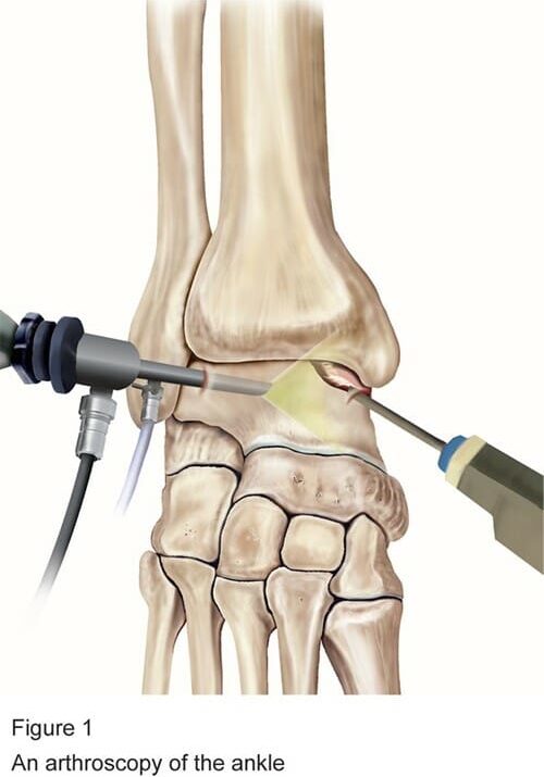 eido_ankle-arthroscopy