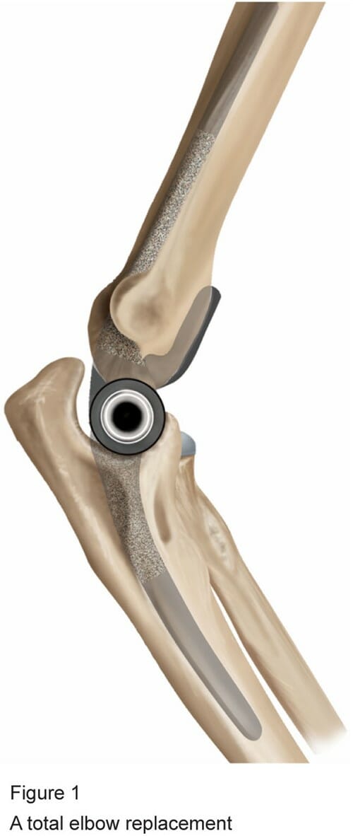 Private Total Elbow Replacement Surgery The Horder Centre
