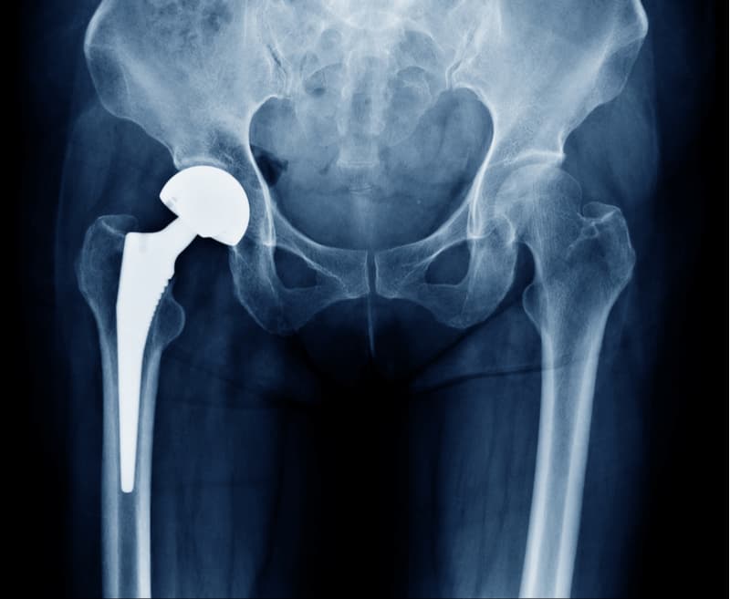 hip-replacement