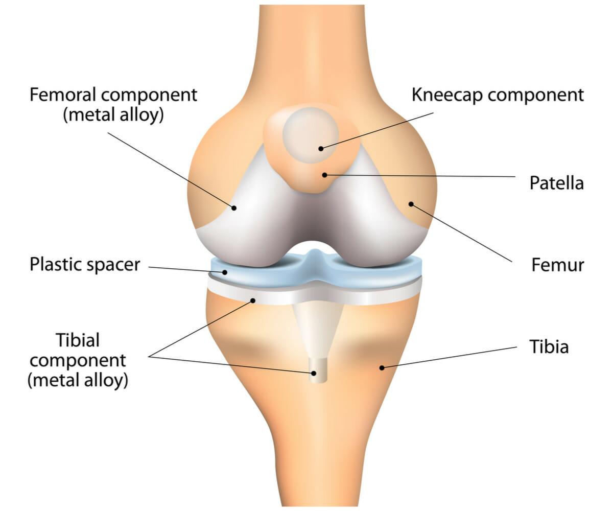knee replacement parts